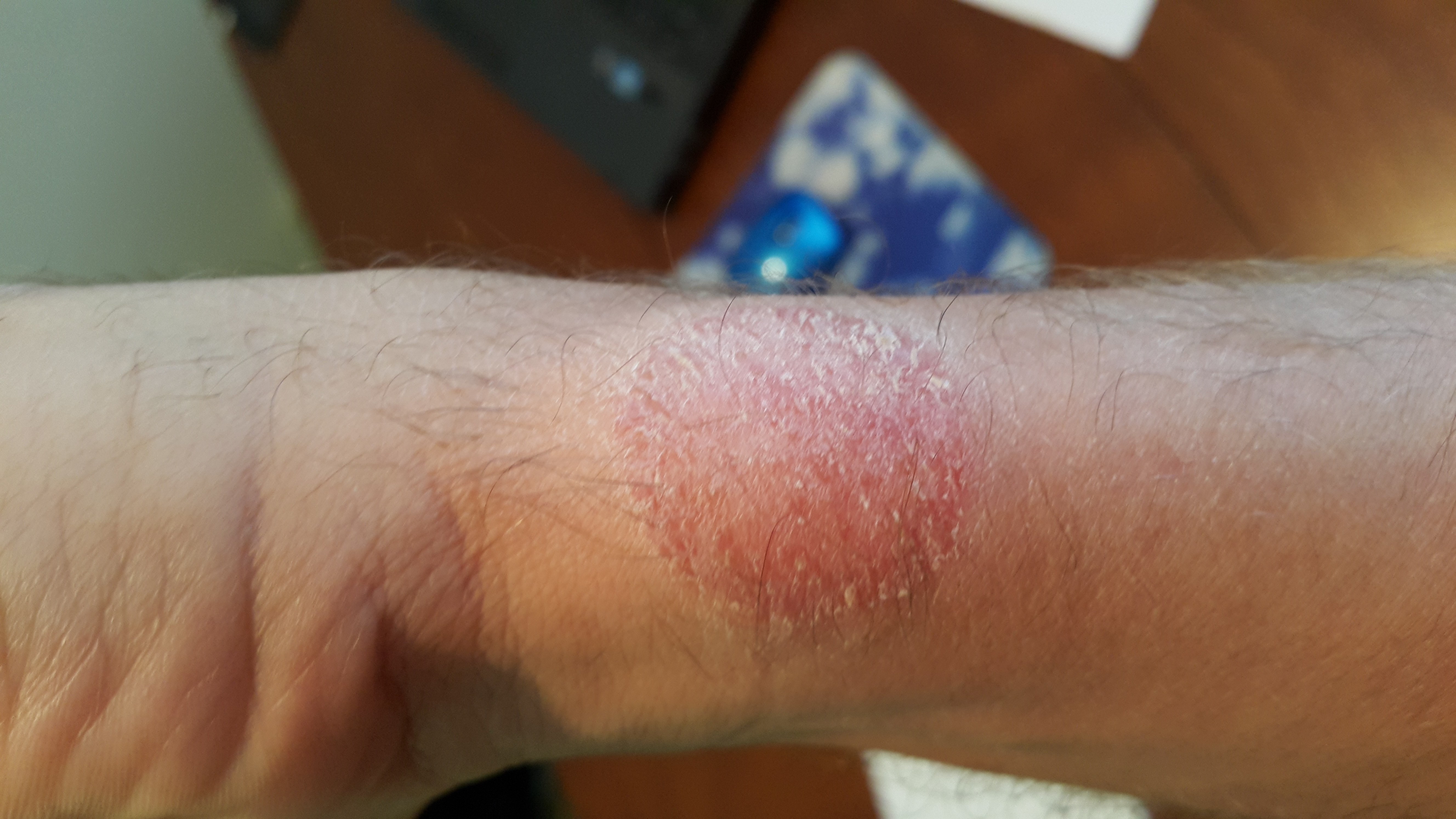 ringworm from mosquito bite